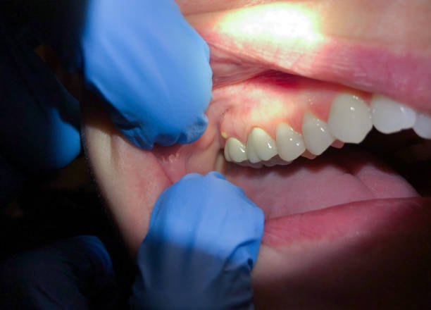 Best Emergency Root Canal Treatment in Moore, OK
